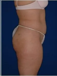 Arms, Thighs & Flanks: after surgery