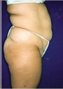 Arms, Thighs & Flanks: before surgery