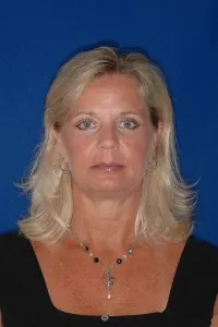 Eyelid Tuck: after surgery