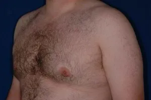 Male Breast Reduction: after surgery