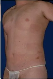 Liposuction: after surgery