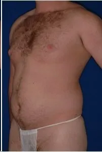 Liposuction: before surgery
