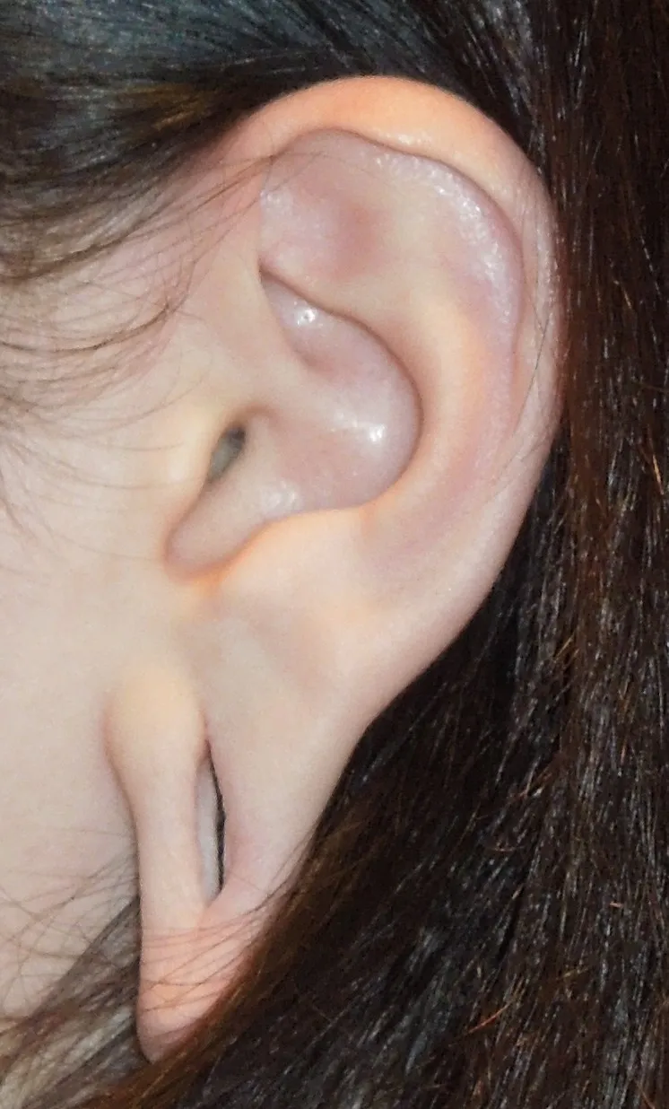 Reconstructive case, before surgery
