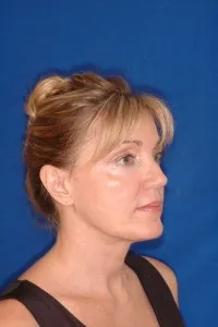 Ultrasonic Neck Lift: after surgery