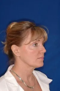 Ultrasonic Neck Lift: before surgery